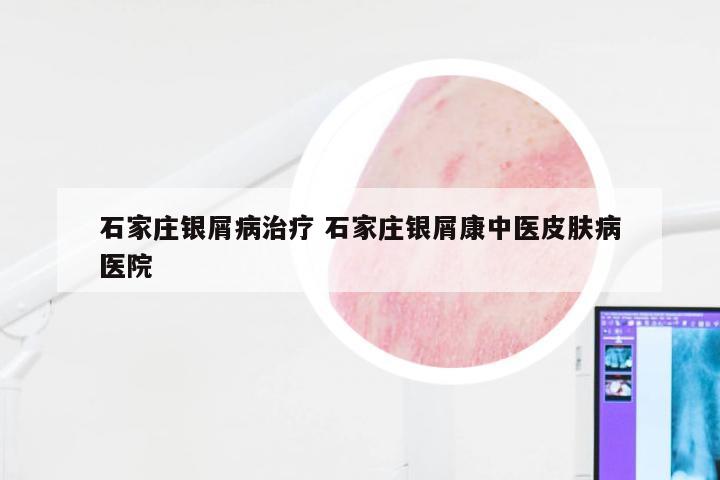 石家庄银屑病治疗 石家庄银屑康中医皮肤病医院