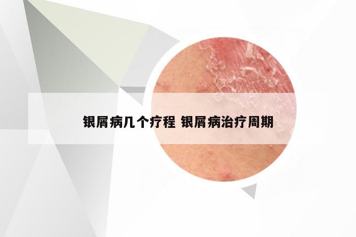 银屑病几个疗程 银屑病治疗周期