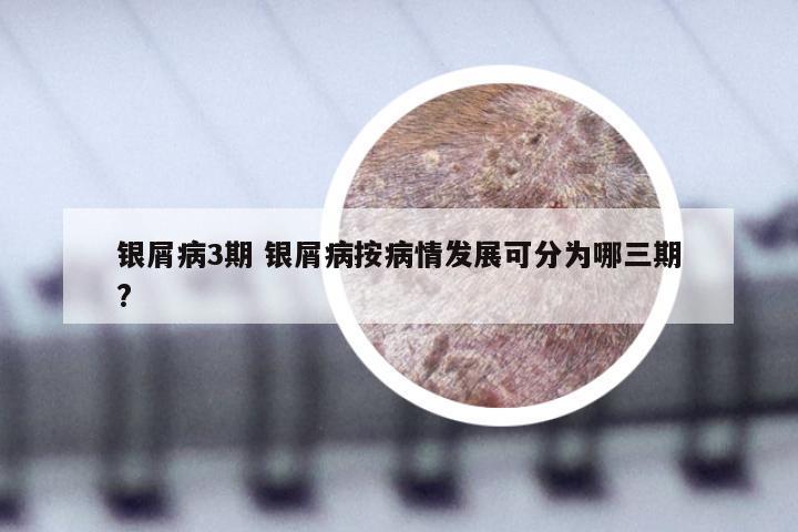 银屑病3期 银屑病按病情发展可分为哪三期?