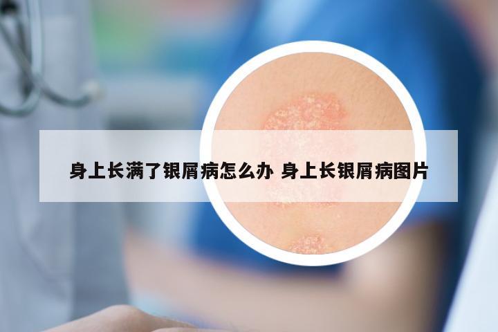 身上长满了银屑病怎么办 身上长银屑病图片
