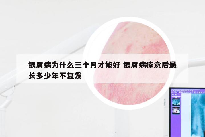 银屑病为什么三个月才能好 银屑病痊愈后最长多少年不复发