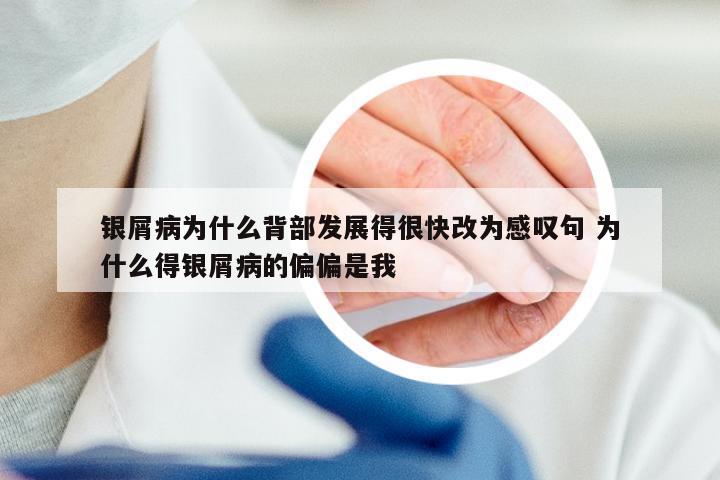 银屑病为什么背部发展得很快改为感叹句 为什么得银屑病的偏偏是我