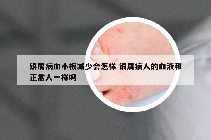 银屑病血小板减少会怎样 银屑病人的血液和正常人一样吗