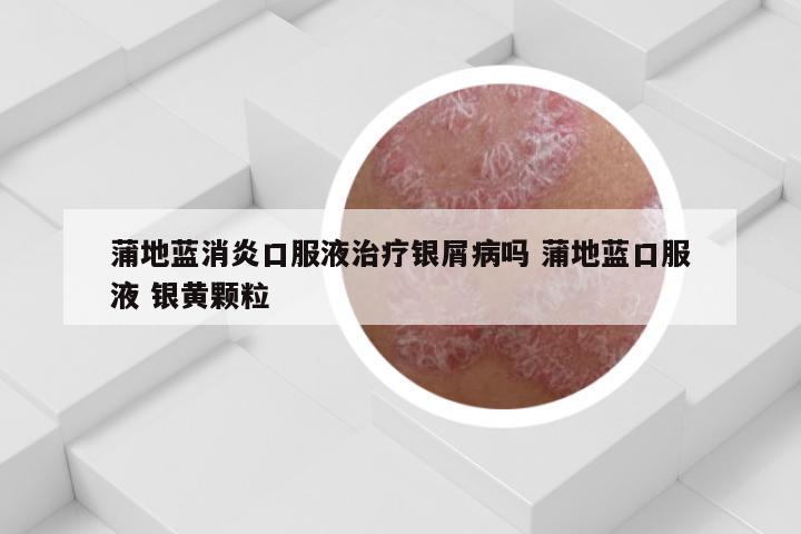 蒲地蓝消炎口服液治疗银屑病吗 蒲地蓝口服液 银黄颗粒