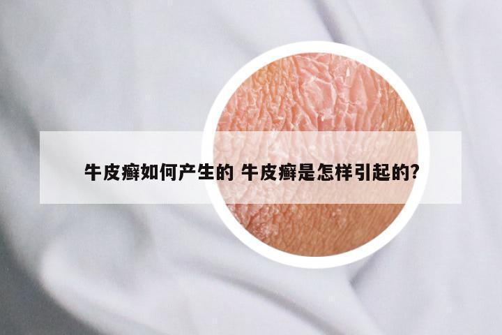 牛皮癣如何产生的 牛皮癣是怎样引起的?