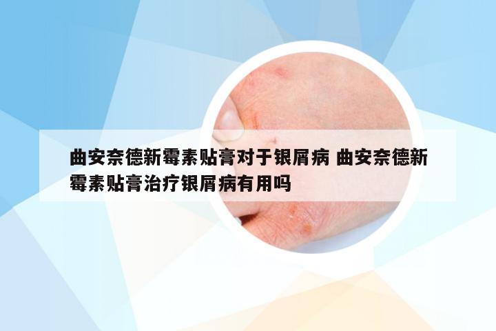 曲安奈德新霉素贴膏对于银屑病 曲安奈德新霉素贴膏治疗银屑病有用吗