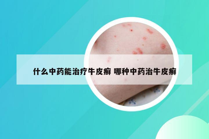 什么中药能治疗牛皮癣 哪种中药治牛皮癣