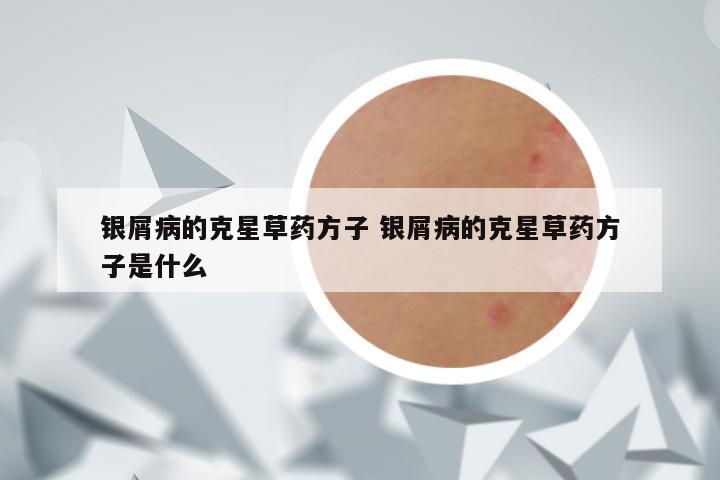 银屑病的克星草药方子 银屑病的克星草药方子是什么