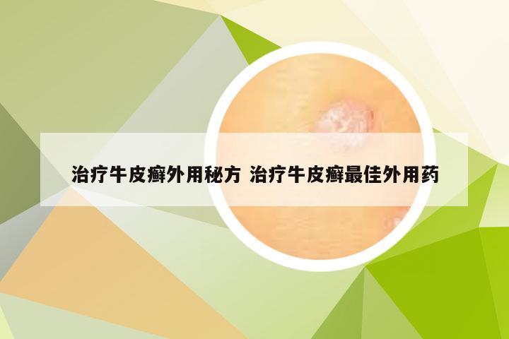 治疗牛皮癣外用秘方 治疗牛皮癣最佳外用药
