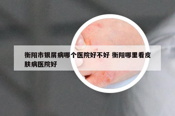 衡阳市银屑病哪个医院好不好 衡阳哪里看皮肤病医院好