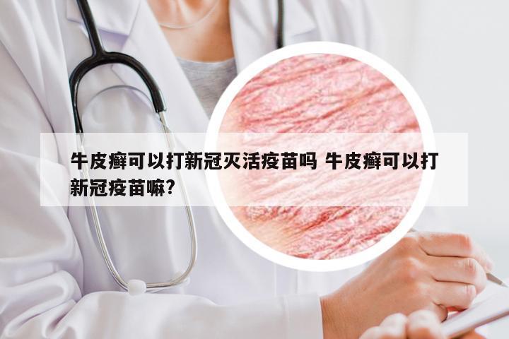 牛皮癣可以打新冠灭活疫苗吗 牛皮癣可以打新冠疫苗嘛?
