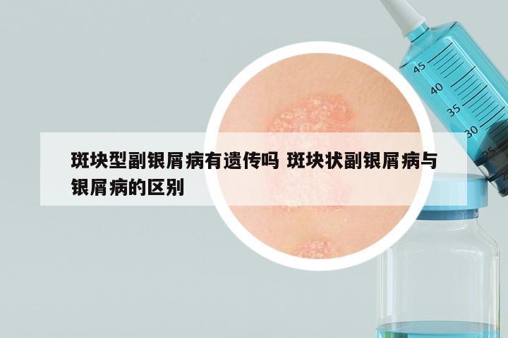 斑块型副银屑病有遗传吗 斑块状副银屑病与银屑病的区别