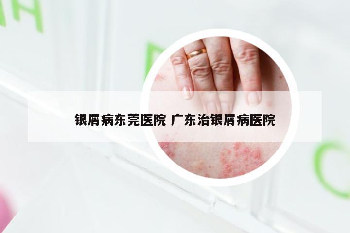 银屑病东莞医院 广东治银屑病医院