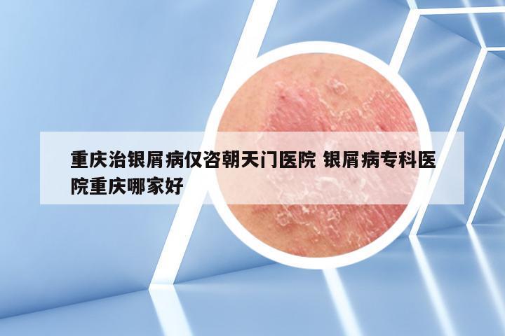 重庆治银屑病仅咨朝天门医院 银屑病专科医院重庆哪家好