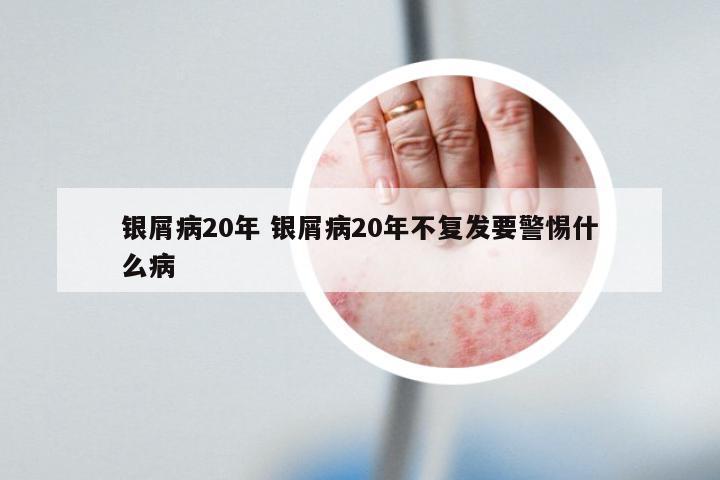 银屑病20年 银屑病20年不复发要警惕什么病