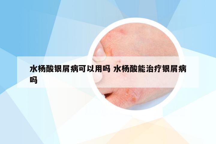 水杨酸银屑病可以用吗 水杨酸能治疗银屑病吗
