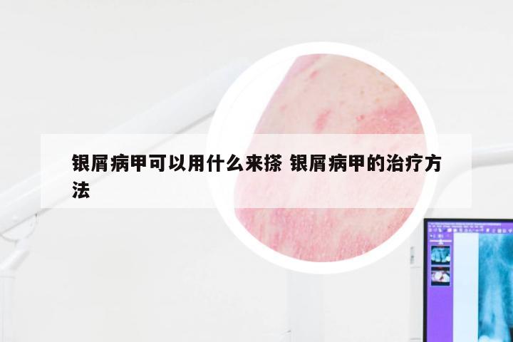 银屑病甲可以用什么来搽 银屑病甲的治疗方法