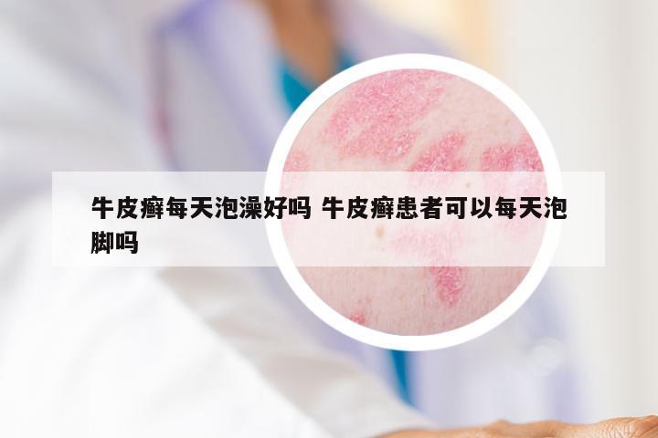 牛皮癣每天泡澡好吗 牛皮癣患者可以每天泡脚吗