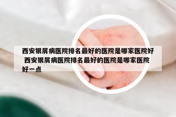 西安银屑病医院排名最好的医院是哪家医院好 西安银屑病医院排名最好的医院是哪家医院好一点