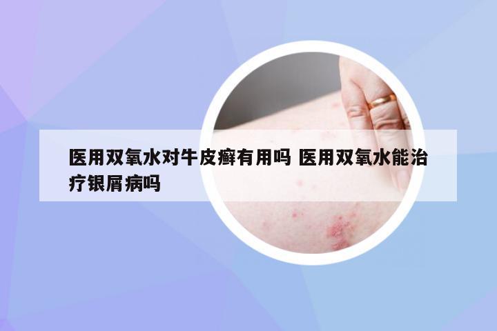 医用双氧水对牛皮癣有用吗 医用双氧水能治疗银屑病吗