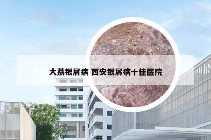 大荔银屑病 西安银屑病十佳医院
