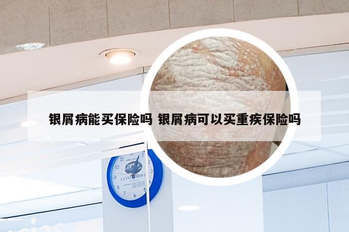银屑病能买保险吗 银屑病可以买重疾保险吗