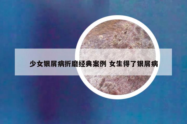 少女银屑病折磨经典案例 女生得了银屑病