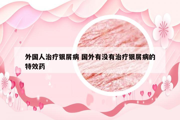 外国人治疗银屑病 国外有没有治疗银屑病的特效药