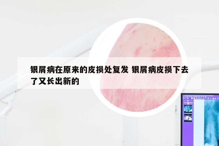 银屑病在原来的皮损处复发 银屑病皮损下去了又长出新的