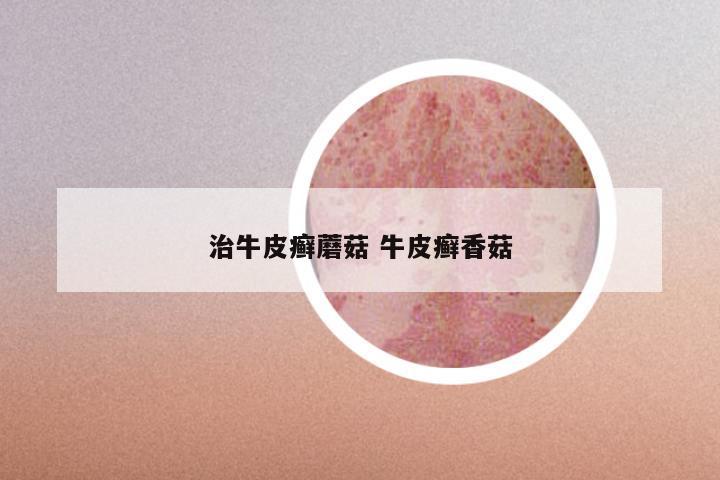 治牛皮癣蘑菇 牛皮癣香菇
