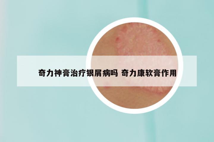 奇力神膏治疗银屑病吗 奇力康软膏作用