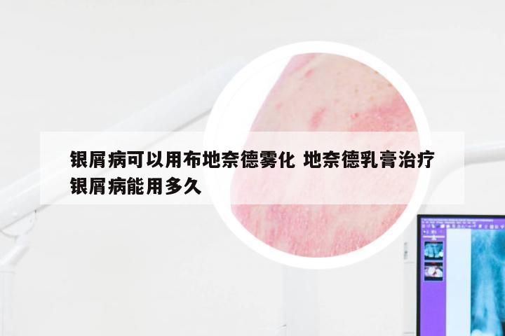 银屑病可以用布地奈德雾化 地奈德乳膏治疗银屑病能用多久