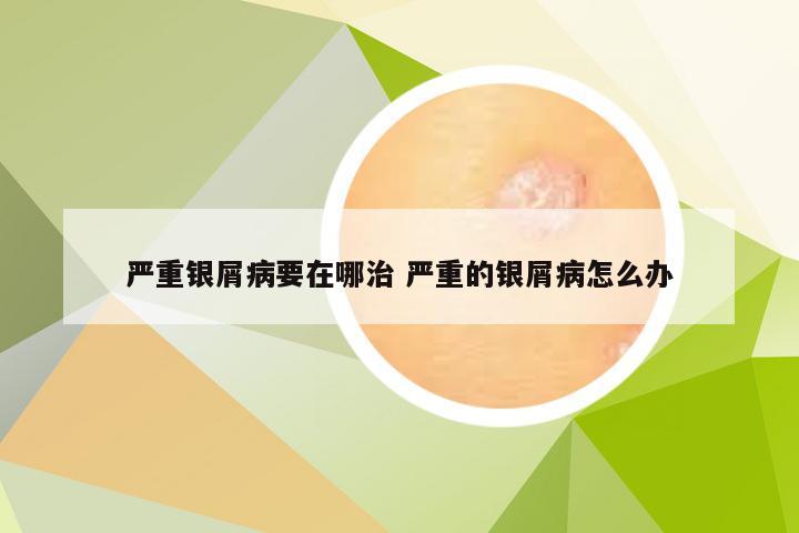 严重银屑病要在哪治 严重的银屑病怎么办