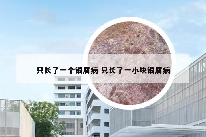只长了一个银屑病 只长了一小块银屑病