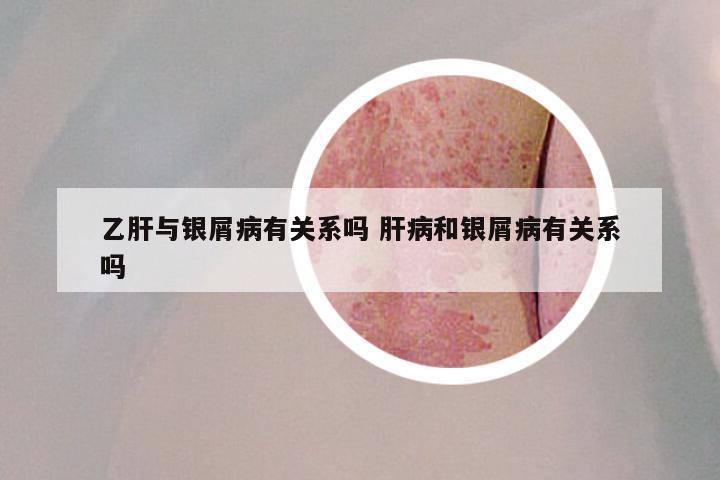 乙肝与银屑病有关系吗 肝病和银屑病有关系吗