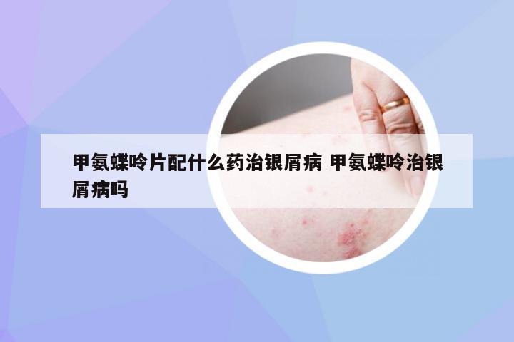 甲氨蝶呤片配什么药治银屑病 甲氨蝶呤治银屑病吗