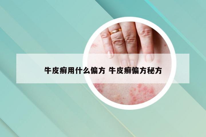 牛皮癣用什么偏方 牛皮癣偏方秘方