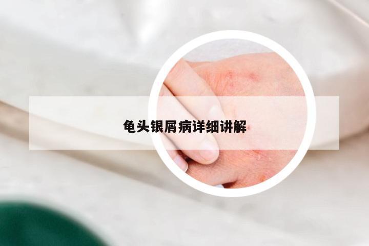 龟头银屑病详细讲解