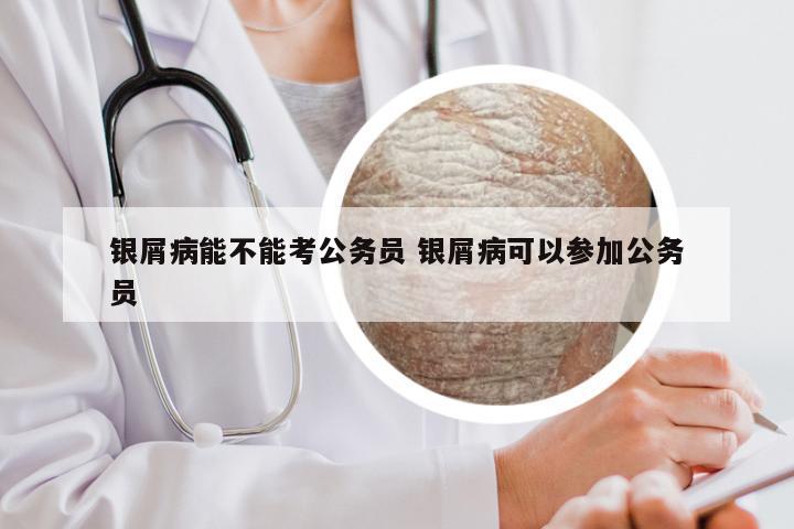 银屑病能不能考公务员 银屑病可以参加公务员