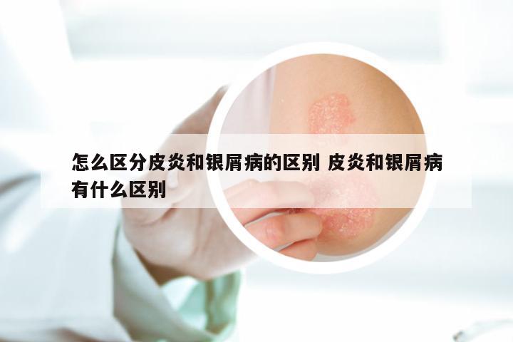 怎么区分皮炎和银屑病的区别 皮炎和银屑病有什么区别