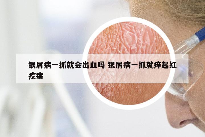 银屑病一抓就会出血吗 银屑病一抓就痒起红疙瘩