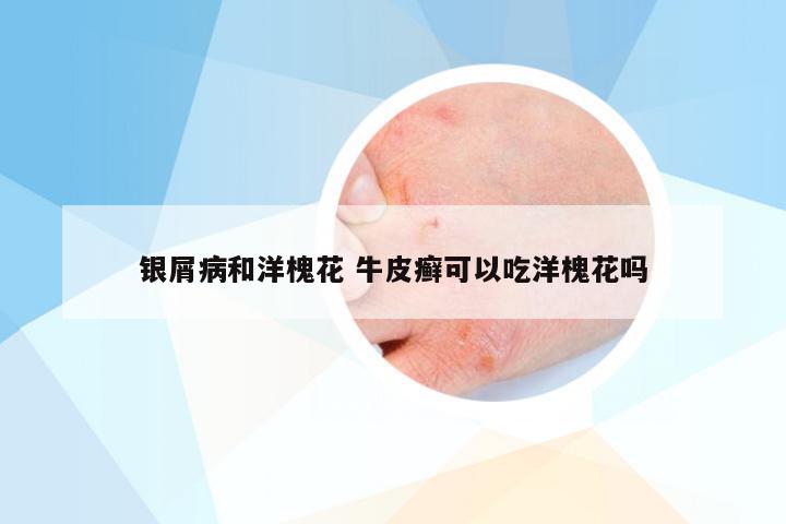 银屑病和洋槐花 牛皮癣可以吃洋槐花吗