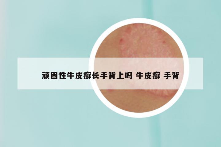 顽固性牛皮癣长手背上吗 牛皮癣 手背