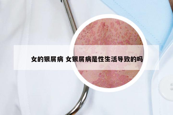 女的银屑病 女银屑病是性生活导致的吗