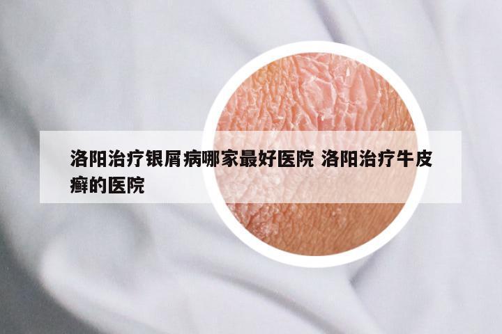 洛阳治疗银屑病哪家最好医院 洛阳治疗牛皮癣的医院