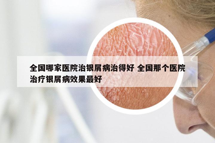 全国哪家医院治银屑病治得好 全国那个医院治疗银屑病效果最好