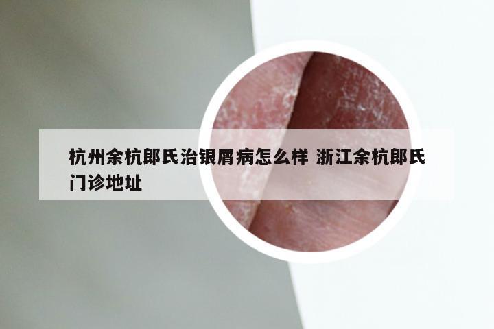 杭州余杭郎氏治银屑病怎么样 浙江余杭郎氏门诊地址