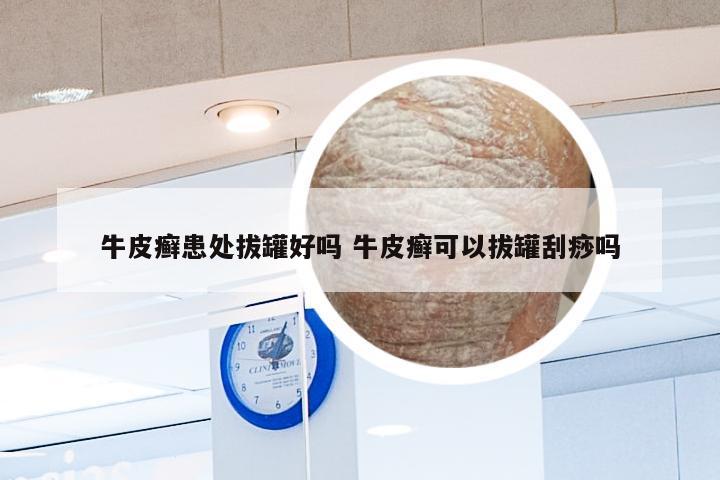 牛皮癣患处拔罐好吗 牛皮癣可以拔罐刮痧吗
