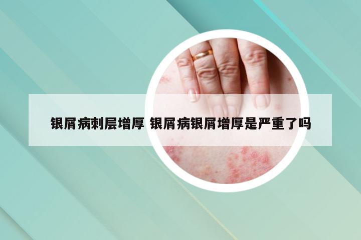 银屑病刺层增厚 银屑病银屑增厚是严重了吗
