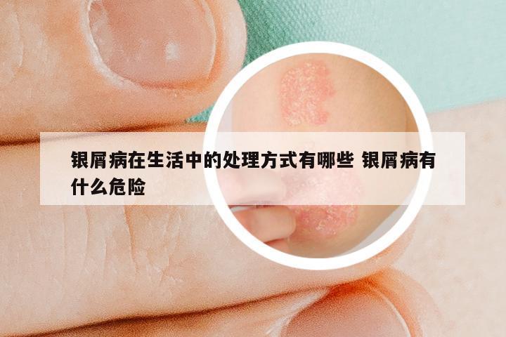 银屑病在生活中的处理方式有哪些 银屑病有什么危险